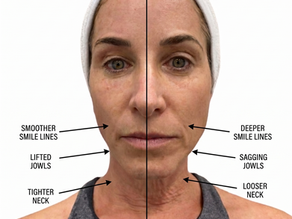 XERF™ Treatment: Everything You Need to Know About Structural Skin Tightening