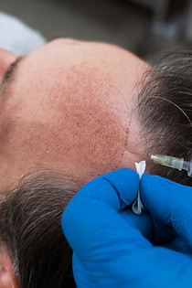 man-getting-hair-loss-treatment.jpg