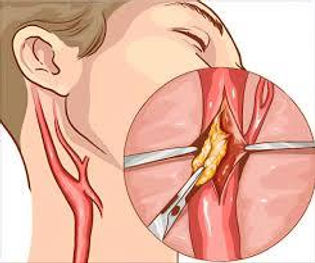 Carotid artery plaque