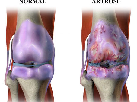 Você sabe o que é osteoartrite (artrose)?