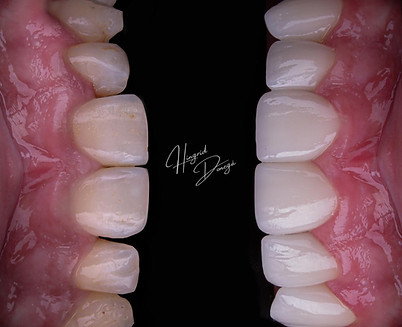 lente de contato dental