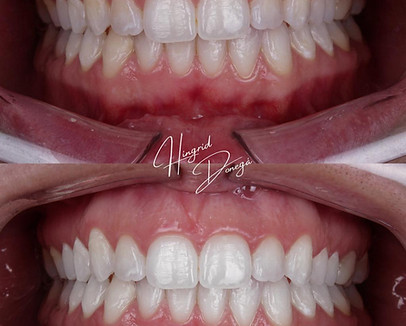 clareamento dental em alphaville