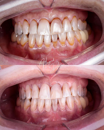 dente escurecido depois do canal