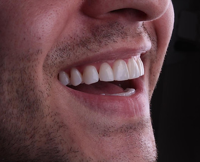 lente de contato dental em alphaville