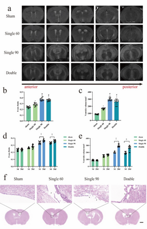 Progressive histological and behavioral deterioration of a novel mouse model of secondary hydrocephalus after subarachnoid hemorrhage.