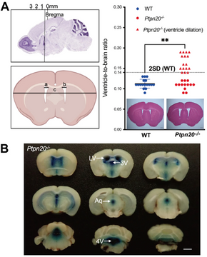 Ptpn20 deletion in H-Tx rats enhances phosphorylation of the NKCC1 cotransporter in the choroid plexus: an evidence of genetic risk for hydrocephalus in an experimental study.