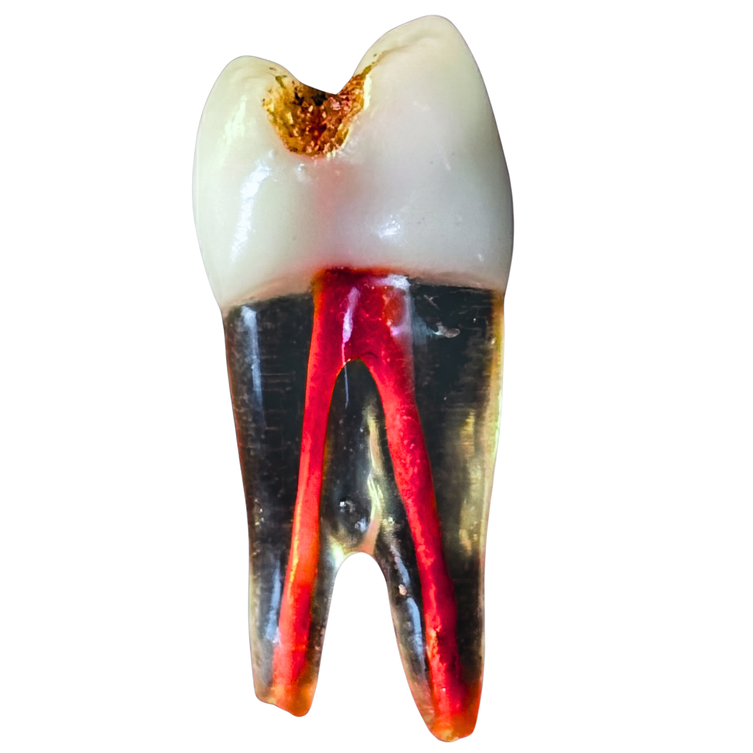 EndoClear CARIES 14 ART