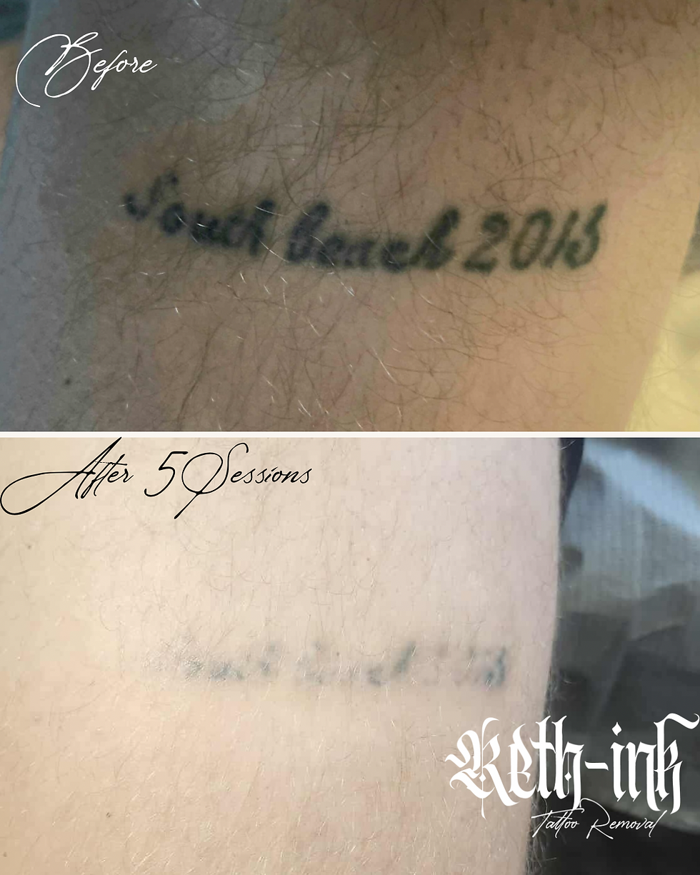 script tattoo removal done at reth-ink in hamilton ont