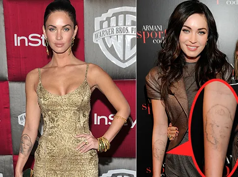 megan fox tattoo removal 