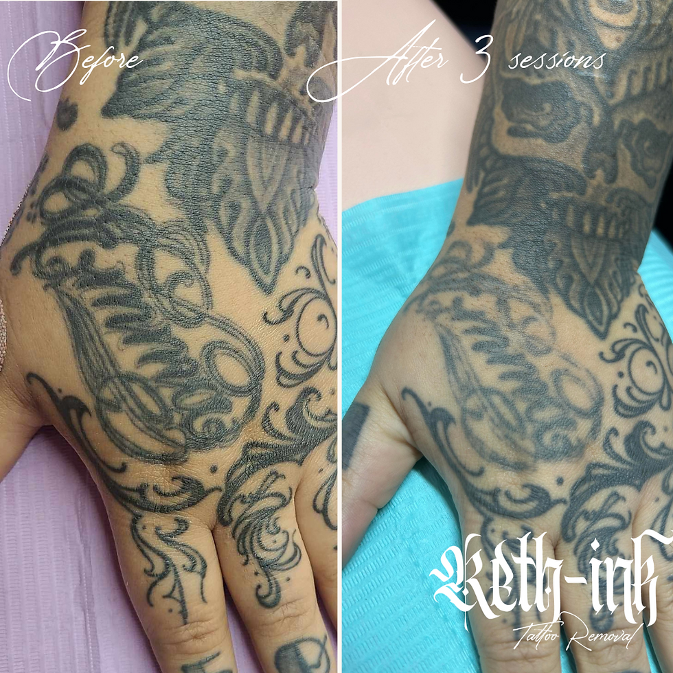 Picosecond laser in use on darker skin tone – Safe, precise tattoo removal session using wavelength settings tailored for melanin-rich skin.