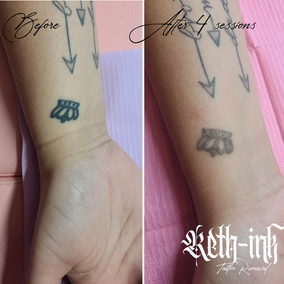 before and after laser tattoo removal results, black crown tattoo on wrist