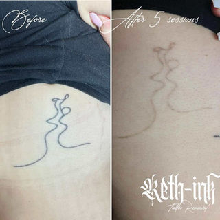 Before and after image illustrating tattoo lightening with pressure-based laser removal