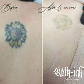 Side-by-side photo of tattoo before treatment and after partial removal using PicoSure Pro