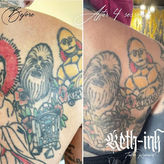 Tattoo removal image demonstrating decreased ink visibility after laser sessions