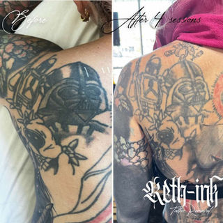 Side-by-side image of tattoo before laser treatment and after multiple sessions