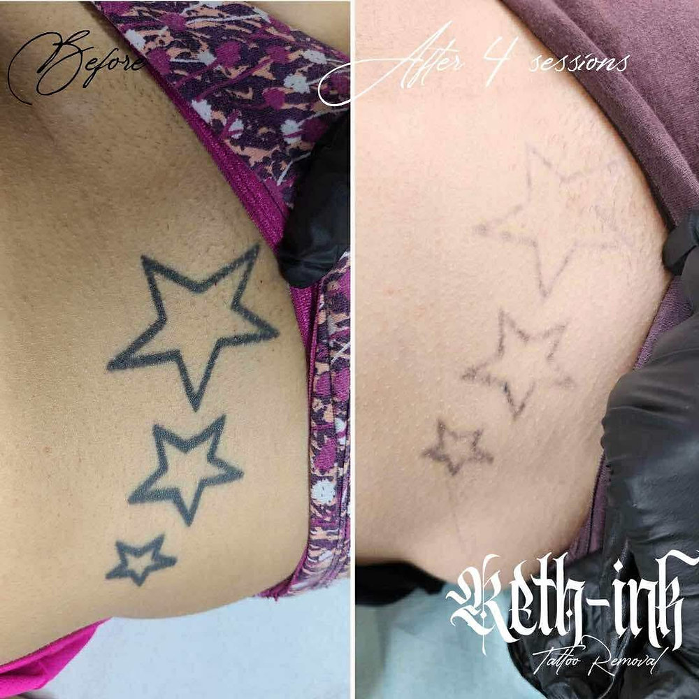 does glutathione fade tattoos Tattoo Removal in Islamabad Pakistan main image 0