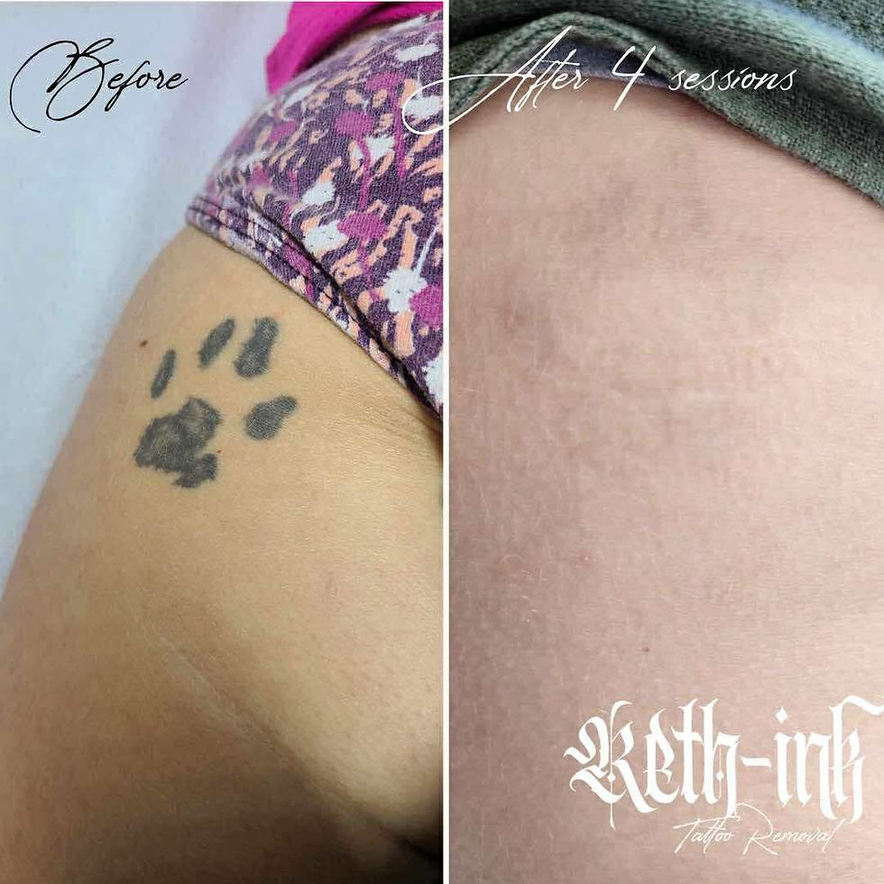 complete tattoo removal of a pawprint tattoo done in hamilton ontario