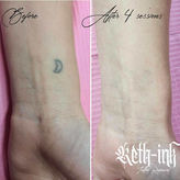 Before and after photo of black ink tattoo lightening with PicoSure Pro laser removal
