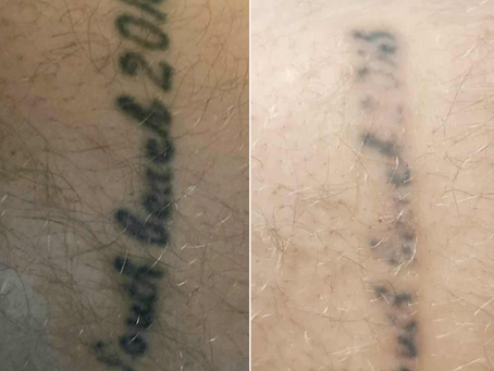 before and after tattoo removal results