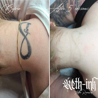 Tattoo removal results showing gradual ink breakdown following multiple PicoSure Pro treatments