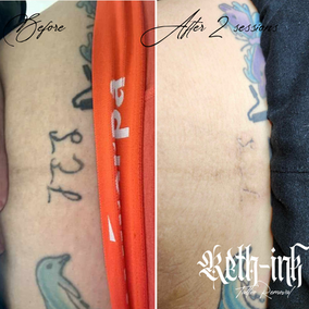 before and after laser tattoo removal results, black lettering tattoo on lower stomach