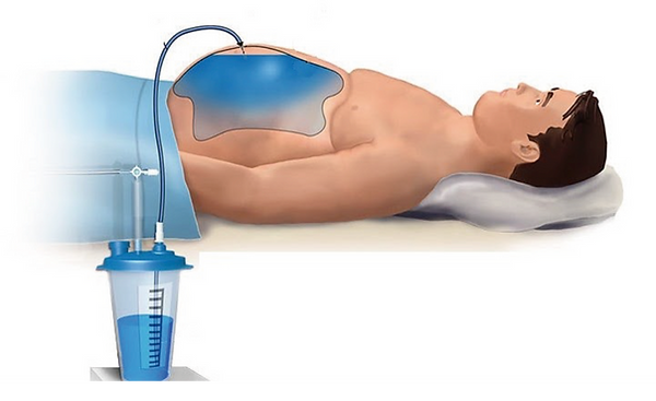paracentesis.png