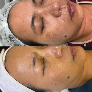Before and after treatment image of a woman's face