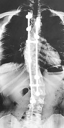 Scoliosis spinal fusion x-ray of a certified personal trainer and corrective exercise specialist in Greenville SC