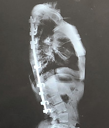 Spinal fusion X ray of the founder and trainer of Gray Training, personal training studio in Greenville SC