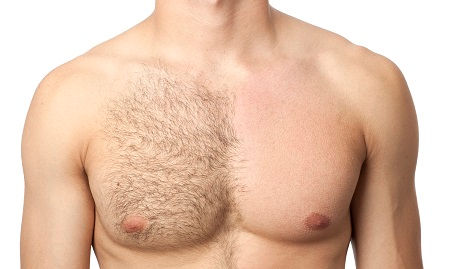 Electrolysis Hair Removal Treatment for Men
