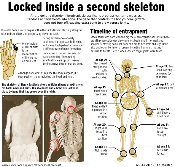 ljg6k7-ljg6iubonedisease.gif