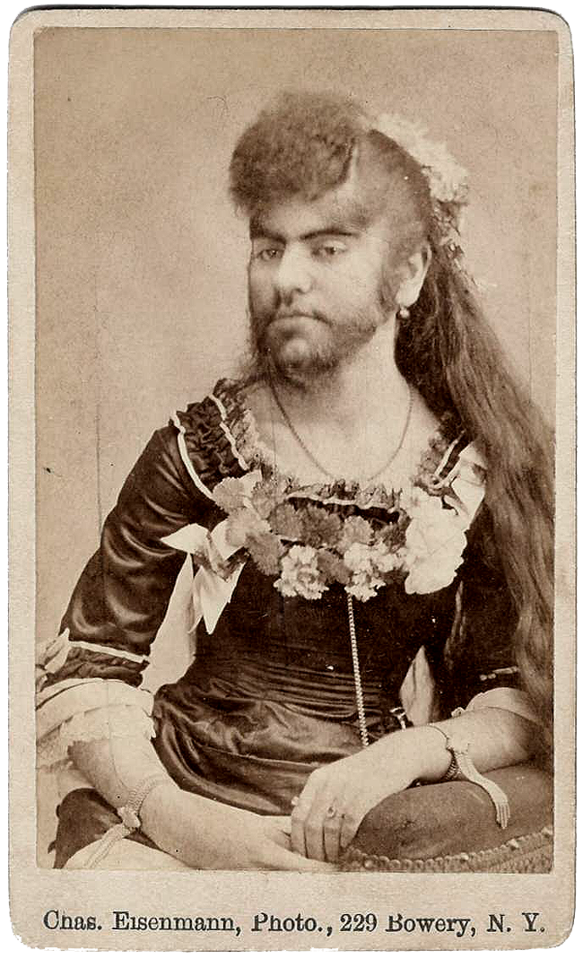 Hirsutism.png