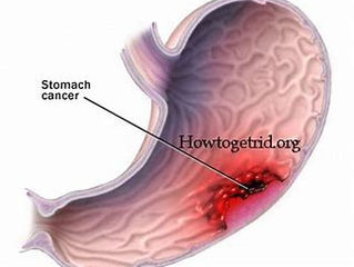 November Is Stomach Cancer Awareness Month
