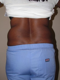 Liposuction-Before