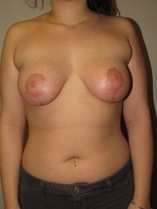 Breast Lift-After
