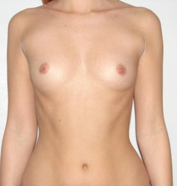 Breast Augmentation-Before