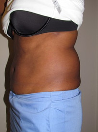 Liposuction-Before
