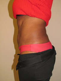Liposuction-After