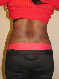 Liposuction-After
