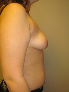 Breast Lift-Before