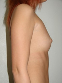 Breast Augmentation-Before