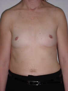 Breast Augmentation-Before