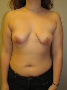 Breast Lift-Before
