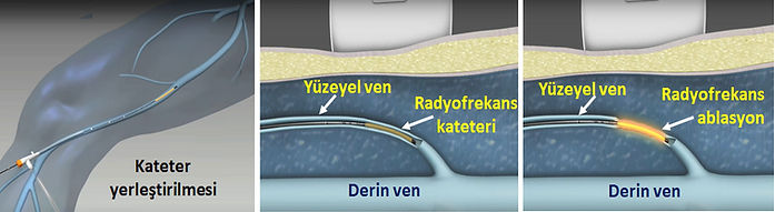 Radyofrekans ablasyonda, yetmezlikli damar ısı ile kapatılarak tahrip edilir.