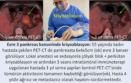 Evre 3 pankreas kanserinde kriyoablasyon ve intratümöral immünoterapi.