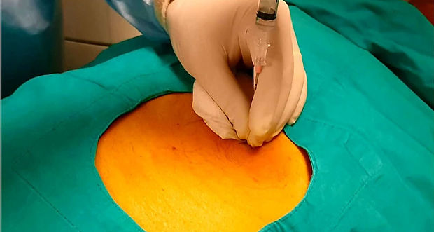 Percutaneous image guided biopsy of the pancreas.