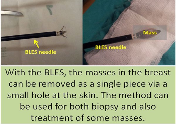 With BLES, it is possible to remove the complete mass in one piece.