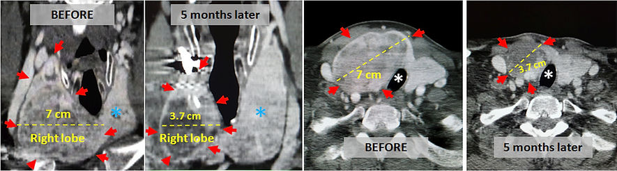 These large thyroid nodules can be easily treated with embolization.