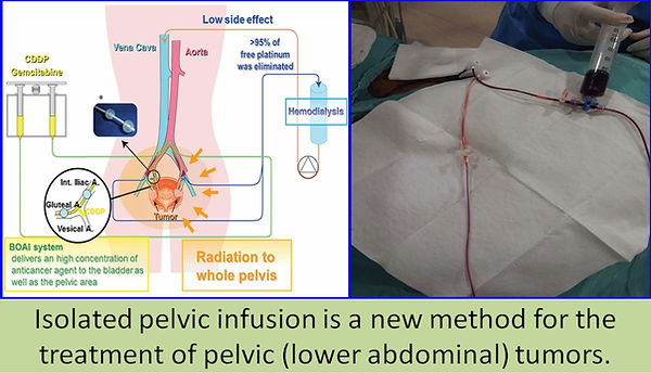 Isolated leg infusion in lower abdominal tumors.
