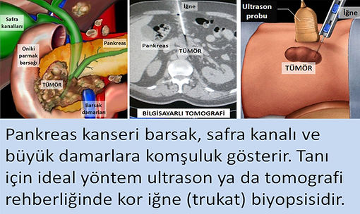 Pankreas kanserinde ideal tanı yöntemi kesici iğne biyopsisidir.
